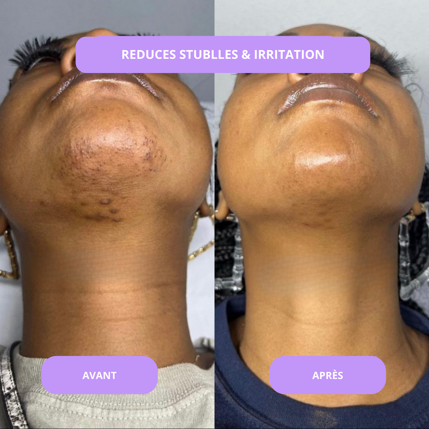 Sérum anti imperfections & contre la pousse des poils